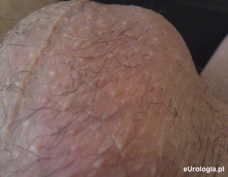 Krosty na mosznie - mieszki włosowe