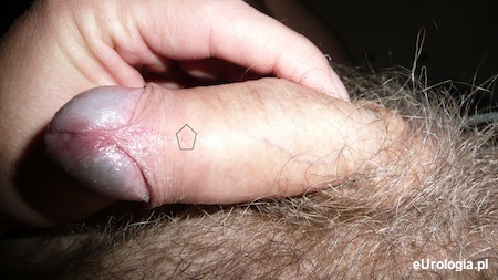 Kr&oacute;tkie wędzidełko - łac. frenulum breve