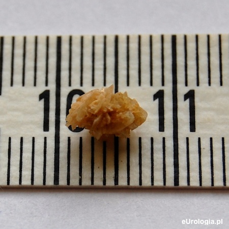 Leczenie ułatwiające wydalenie kamienia z moczowodu