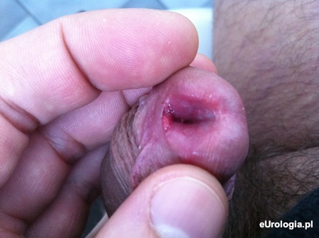 Mięsko ujścia cewki moczowej