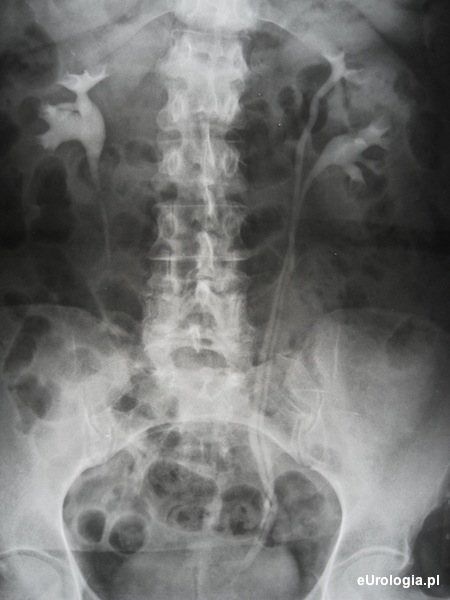Moczow&oacute;d podw&oacute;jny - łac. ureter duplex