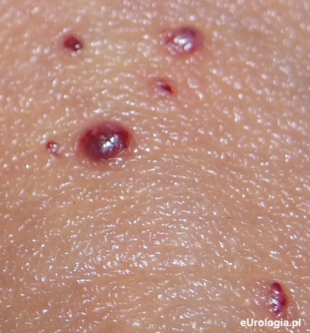 Naczyniak skóra penisa