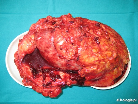 Nefrektomia przezotrzewnowa - preparat