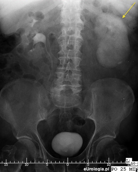 Nefrogram - urografia