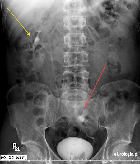 Nerka ektopowa - urografia