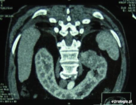 Nerka podkowiasta - tomografia komputerowa