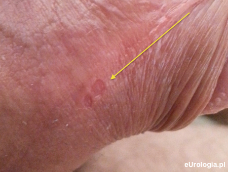 Trudna w gojeniu rana na penisie