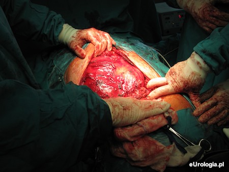 Nieoperacyjny guz prawej nerki