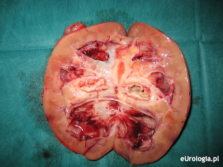 Rak janokom&oacute;rkowy nerki objawiający się krwiomoczem - preparat z nefrektomii