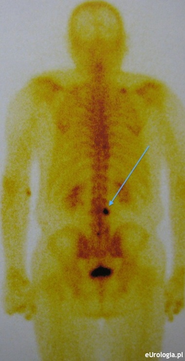 Rak prostaty - przerzuty do kręgosłupa