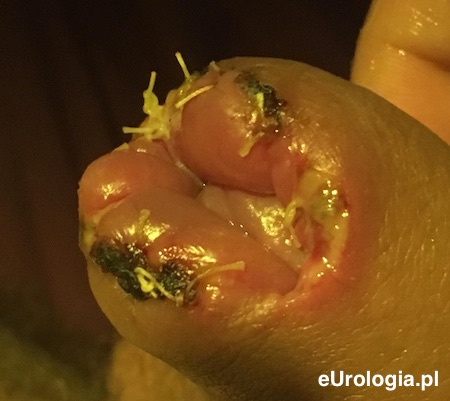 Obrzęk napletka po częściowym obrzezaniu