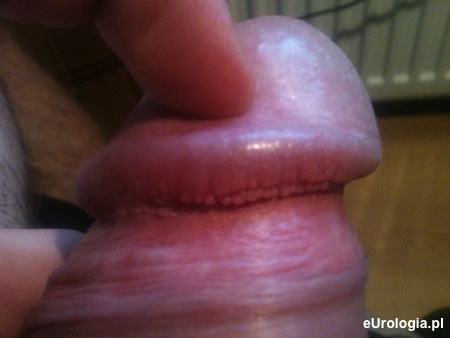 Oderwany żołądź?