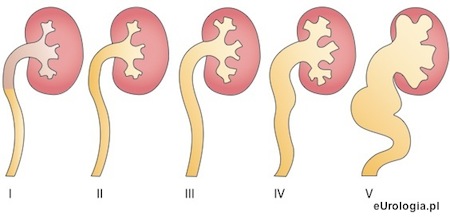 Stopnie odpływu pęcherzowo - moczowodowego
