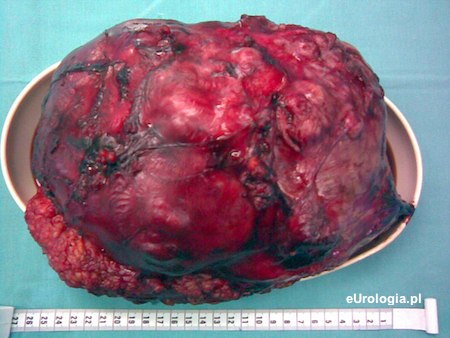 Duży guz nerki - preparat z nefrektomii