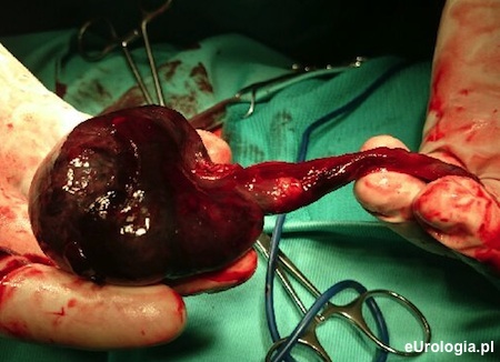 Jądro usunięte w wyniku kulkudniowego skrętu.