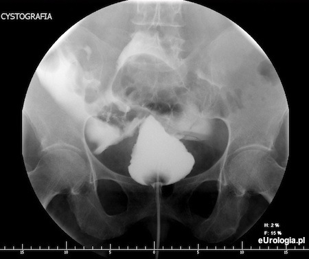 Perforacja pęcherza moczowego