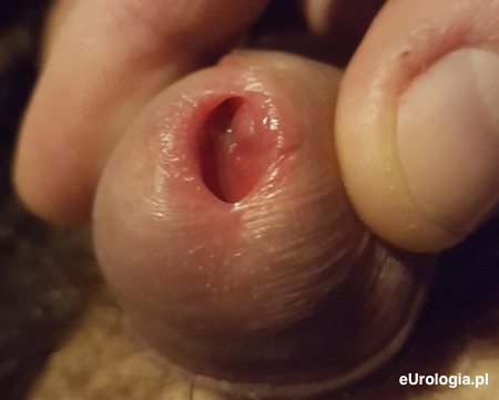Pieczenie ujścia cewki moczowej