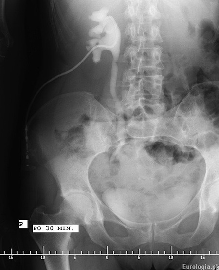 Pielografia zstępująca