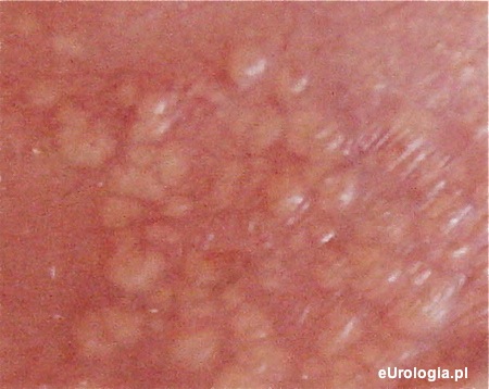 Plamki Fordyce'a - zdjęcie