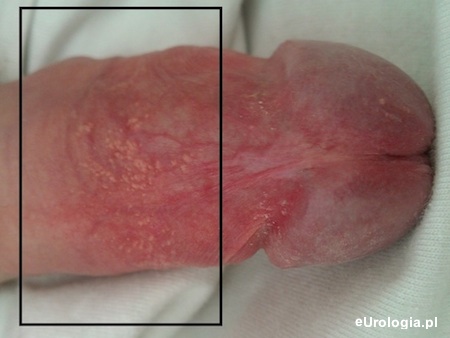 Plamki Fordycea na trzonie prącia