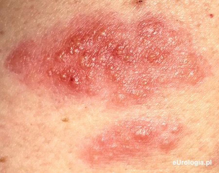 P&oacute;łpasiec - wykwity sk&oacute;rne