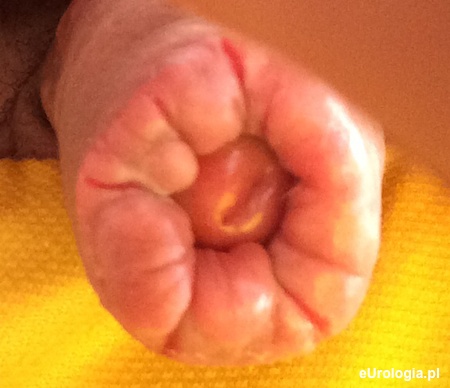 Bliznowacenie popękanego napletka