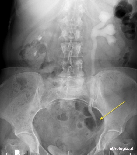 Poszerzony UKM i moczow&oacute;d - urografia
