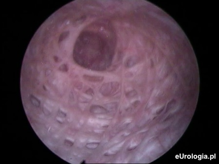 Beleczkowanie i uchyłek w szczycie pęcherza
