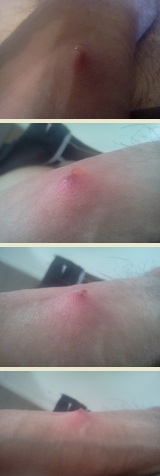 Krosta - pryszcz na penisie