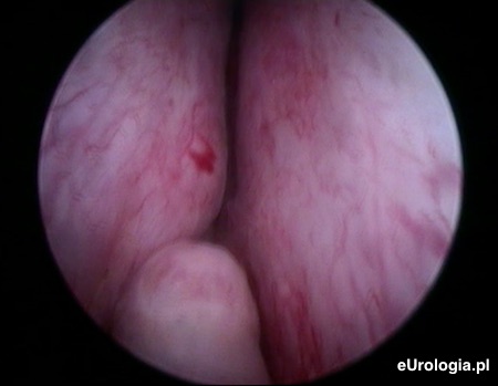 Boczne płaty stercza w łagodnym przeroście prostaty