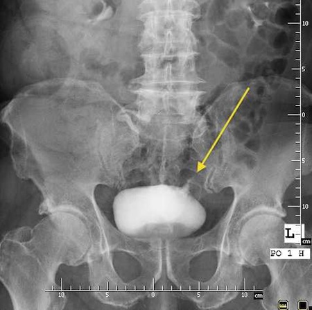 Przetoka pęcherzowo - jelitowa