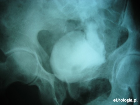 Przetoka pęcherzow - pochwowa