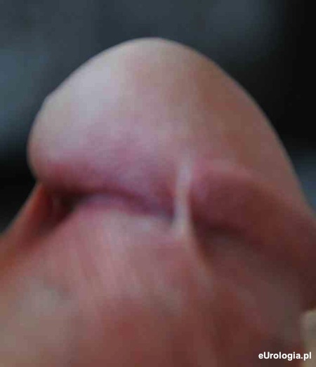 Przyrośnięty napletek