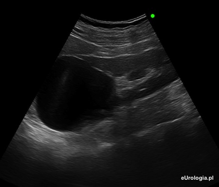 Torbiel prosta g&oacute;rnego bieguna nerki lewej