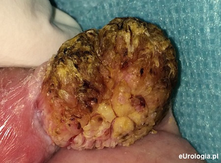 Rak płaskonabłonkowy rogowaciejący prącia - zdjęcie
