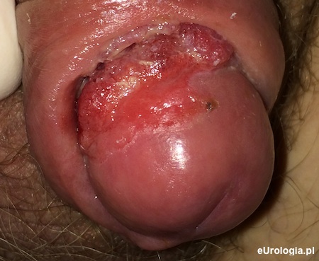 Rak prącia - owrzodzenie żołędzi i rowka zażołędnego