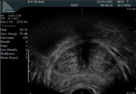 USG transrektalen gruczołu krokowego.