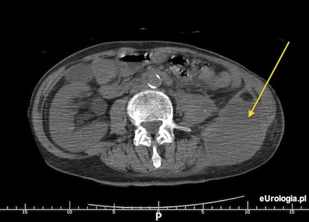 Ropień przestrzeni zaotrzewnowej
