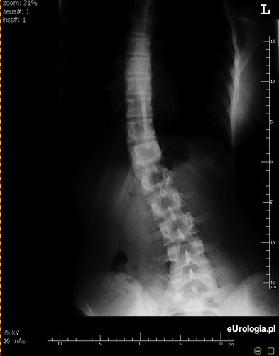 Skolioza - boczne skrzywienie kręgosłupa