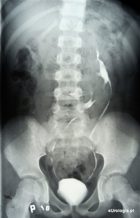 Ektopia skrzyżowana nerki prawej