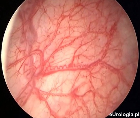 Cystoskopia - śr&oacute;dmiąższowe zapalenie pęcherza