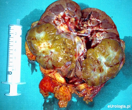 Guz nerki - statystyka złośliwości