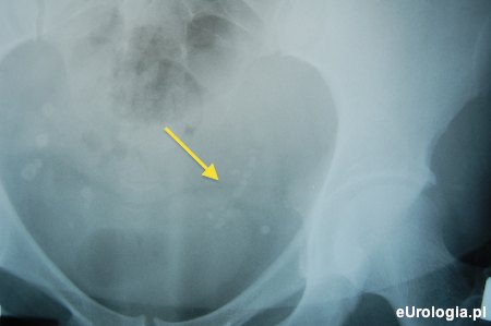 Droga kamicza po ESWL - Steinstrasse