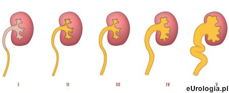 Stopnie refulsu pęcherzowo - moczowodowego