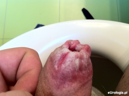 Stulejka zapalna - łac. Phimosis inflammatoria