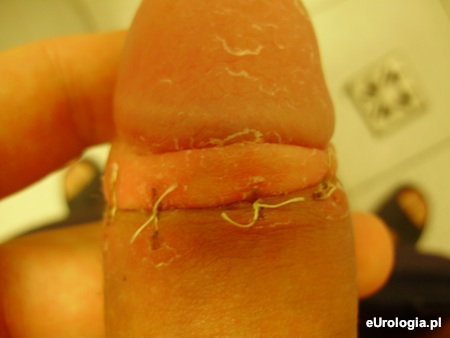 Szwy po obrzezaniu - stalowe czy wchłanialne?