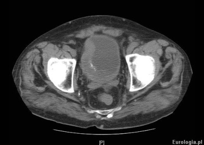 Tomografia - guz pęcherza moczowego