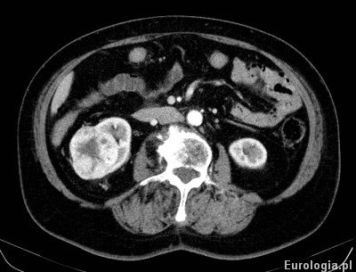 Guz nerki - tomografia komputerowa