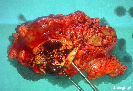 Torbiel nerki - 4 kategoria według skali Bosniaka