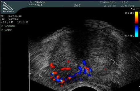TRUS - transrektalna biopsja prostaty - Doppler